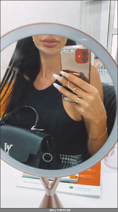 MEGA-FANS – yvonnebar-07-06-2021-Im at the clinic to get LIP fillers right now. Anybody wanting to help me sponsor me will receive a big surprise